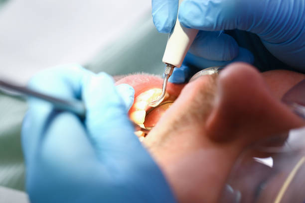 Best Emergency Wisdom Teeth Removal in East Los Angeles, CA